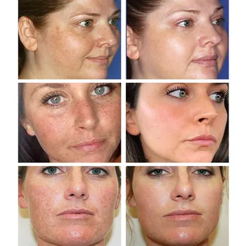 BREYLEE Vitamina C 20% VC Clareamento Facial Creme de Reparação Desaparecer as Sardas Remover Manchas Escuras Melanina Removedor de Branqueamento Creme de Rosto D1